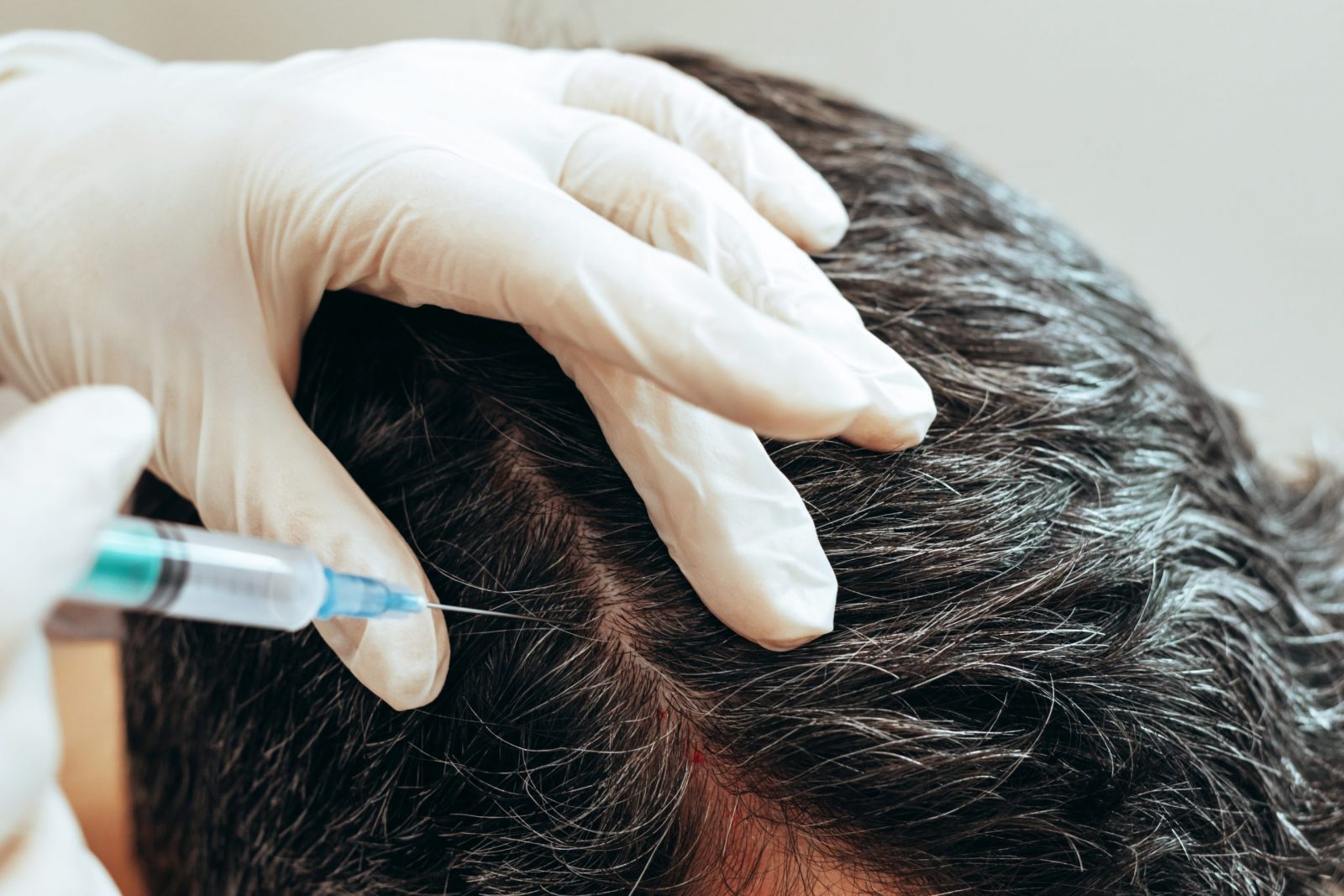 Complications, Recovery, and Procedures of Hair Transplantation