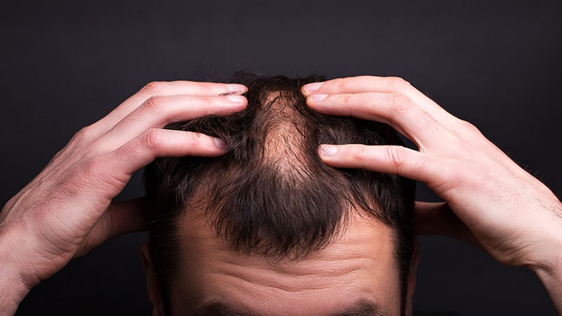 What is temple hair loss and what are the causes?