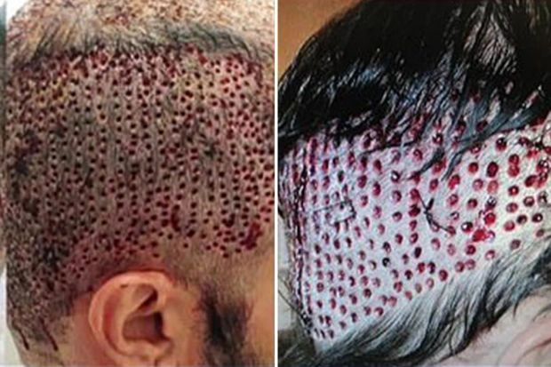 A botched hair transplant: what went wrong?